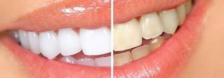 Conheça os diferentes tipos de clareamento dental